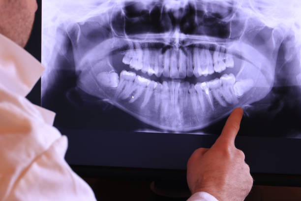 Best Emergency Dentist for Lost Fillings or Crowns in Nashvle, IL